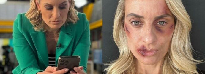 Γεμάτη μώλωπες & πληγές στο πρόσωπο: Οι φωτο της Ελεονώρας Μελέτη μετά το “ξυλοδαρμό” κάνουν τον γύρο του ίντερνετ
