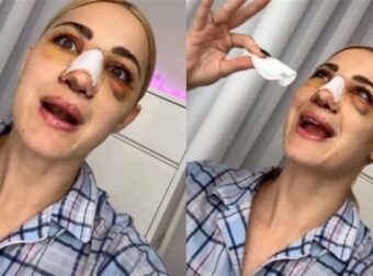 Ιωάννα Τούνη: «Δε μπορούσα να ανοίξω τα μάτια μου…» – Το πρώτο βίντεο μετά την πλαστική επέμβαση στη μύτη της