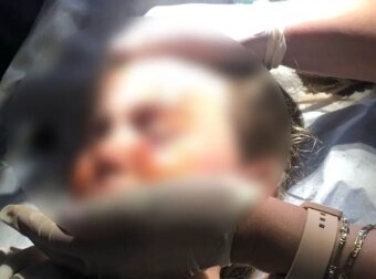 Άγρια επίθεση σκύλου σε κοριτσάκι 4,5 ετών – Τη δάγκωσε στο πρόσωπο – Σκότωσε σκυλάκι πριν λίγες μέρες
