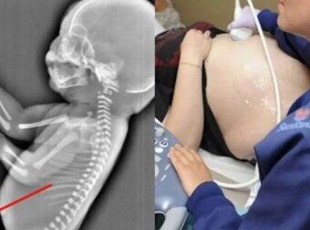 Έγκυος παίρνει την απόφαση να κάνει έκτρωση όταν βλέπει στον υπέρηχο ότι το μωρό της… – Θα σοκαριστείτε