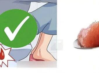 Για ανθρώπους με συχνή δυσκοιλιότητα – Μόνο ένα κουταλάκι από αυτό το πρωί