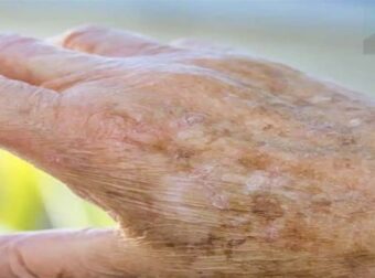 Αν εμφανιστούν κηλίδες στα χέρια μας, αυτά πρέπει να ξέρετε…