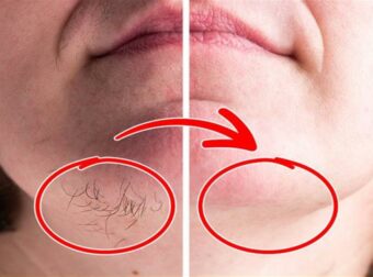 Τριχοφυΐα στο πρόσωπο: Αποτελεσματική, σπιτική συνταγή για να εξαφανίσετε τις ανεπιθύμητες τρίχες με φυσικό τρόπο