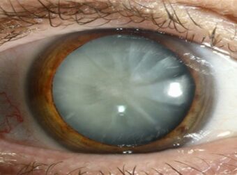 Καταρράκτης ματιών: τι είναι, πρώτα συμπτώματα, επέμβαση και σύγχρονη θεραπεία