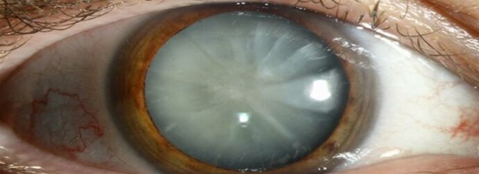 Καταρράκτης ματιών: τι είναι, πρώτα συμπτώματα, επέμβαση και σύγχρονη θεραπεία