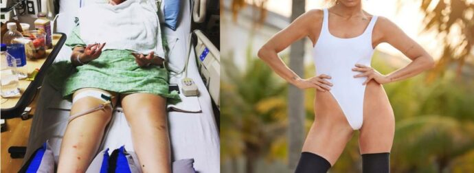 Λόρεν Γουάσερ: Πώς από ένα ταμπόν έχασε και τα δυο της πόδια – Η τραγική ιστορία με το προϊόν που χρησιμοποιεί το 90% των γυναικών