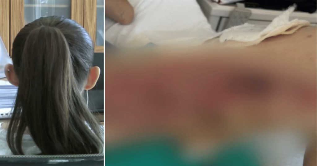 Συγκλονίζει η 20χρονη εγκαυματίας στη Θεσσαλονίκη: «Ο γιατρός μου έριξε ένα υγρό και άρχισα να καίγομαι αφόρητα»