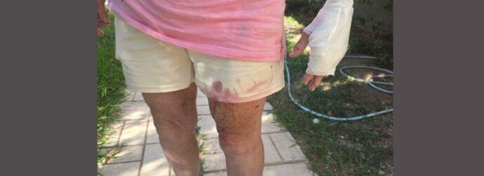 Σκυλιά που φέρονται να ανήκουν σε συγγενικό πρόσωπο του Στέφανου Τσιτσιπά δάγκωσαν 3 άτομα στη Βάρη