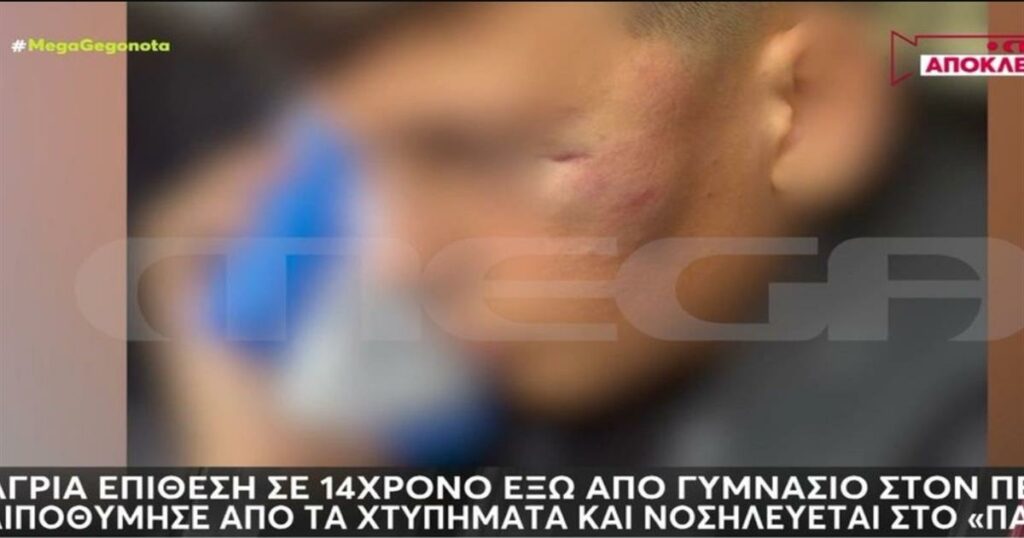 Με βαριές κρανιοεγκεφαλικές κακώσεις 14χρονος που δέχτηκε επίθεση από συμμαθητή του – «Μου λένε “κυρία, πεθαίνει ο μικρός”» (video)